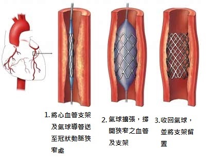 心血管支架放置示意圖