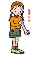 紅疹 紅疹