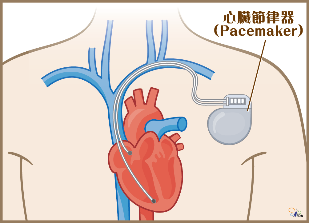 心臟節律器示意圖，圖片內容詳見藥物食品安全週報第1044期內文
